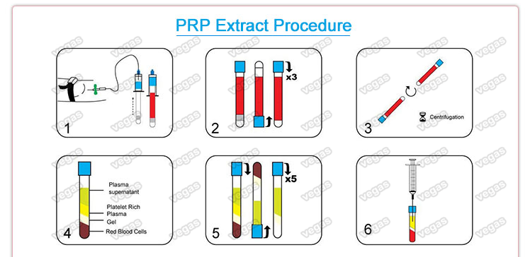 PRP processure