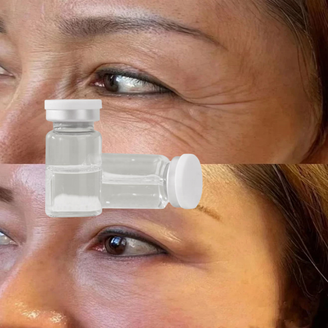 PDRN before and after